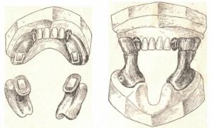 Maxillofacial prosthetics