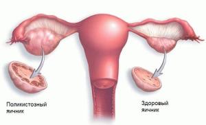 Ako obnoviť menštruačný cyklus: účinné metódy