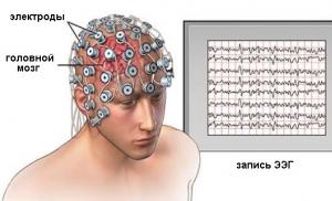 What shows the EEG (electroencephalogram) of the brain